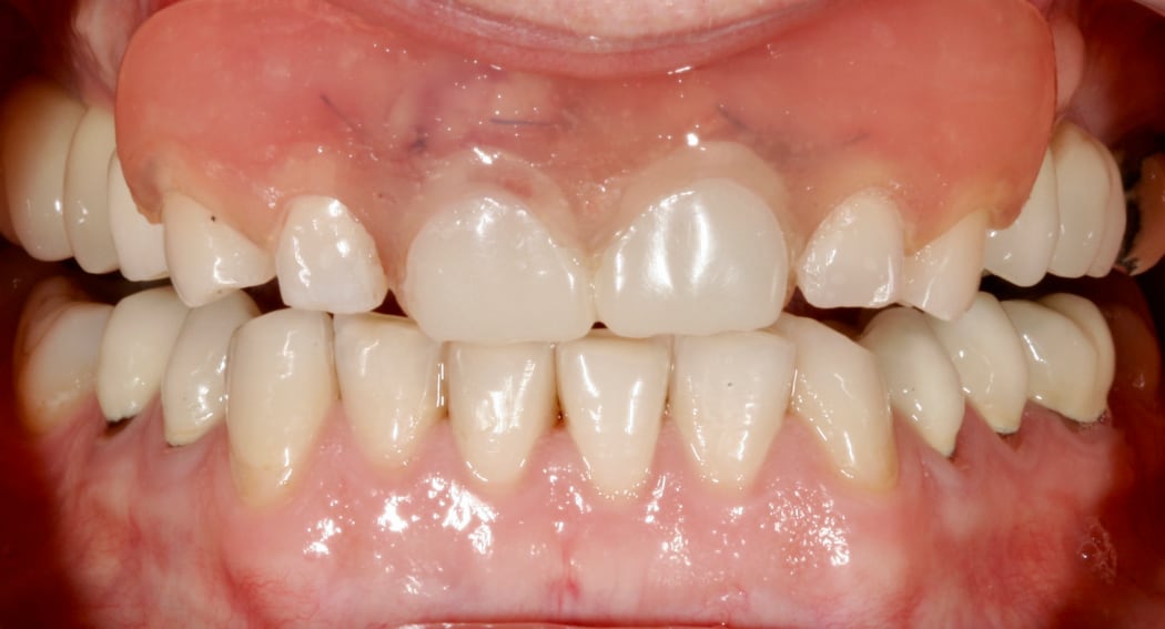 Intraoral_vorher_06
