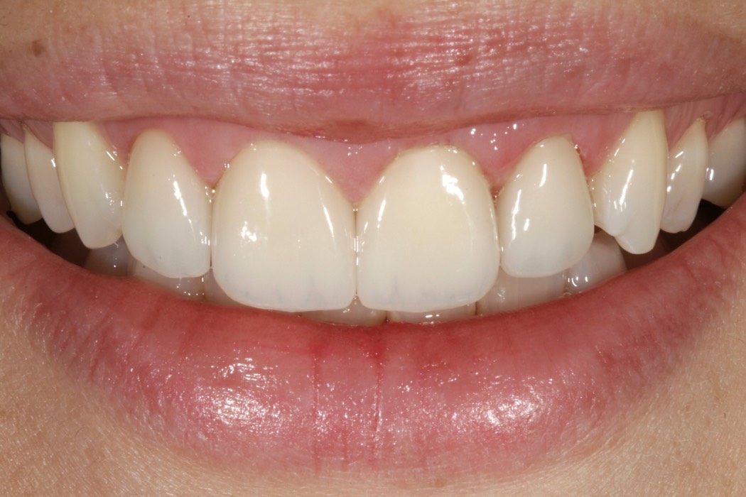 Intraoral_nachher_05